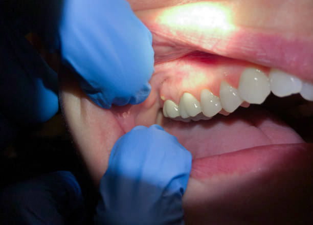 Best Emergency Tooth Extraction in Castlewood, VA